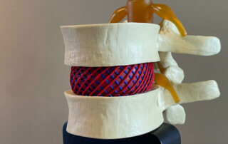 hernia model met gekruiste vezels van de tussenwervelschijf